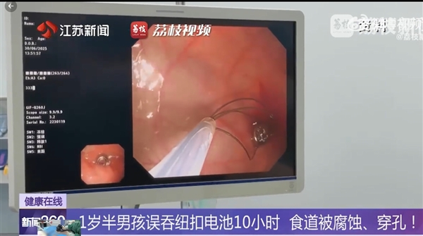 幼儿误吞电池10小时致终身残疾 医生提醒：纽扣电池卡在食道太骇人