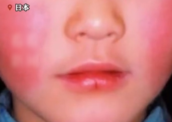 日本“苹果病”流行达到历史顶点：从双颊开始形成网状红斑
