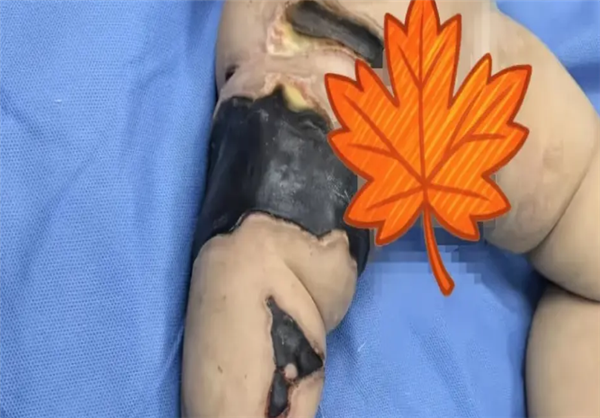 女婴遭虫咬多次抢救全身换血：诊断为脓毒血症 多器官衰竭